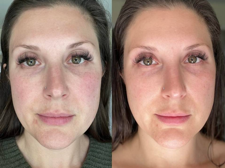 Skin Tightening