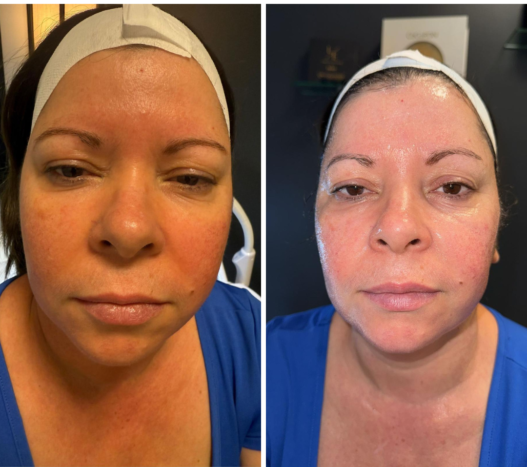 Hydro Facial & Deep Hydration