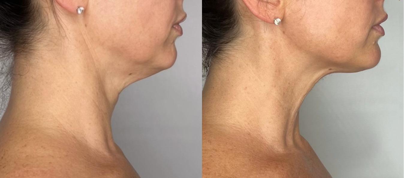 HIFU Face Lifting