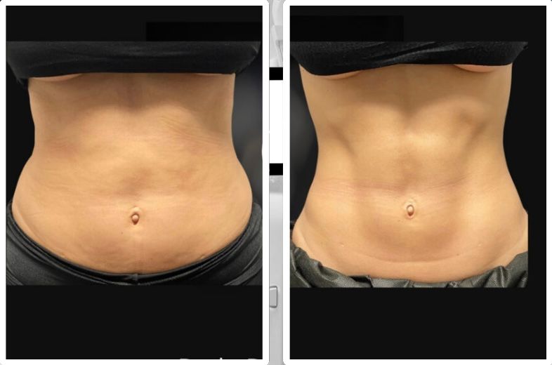 RF Skin Tightening