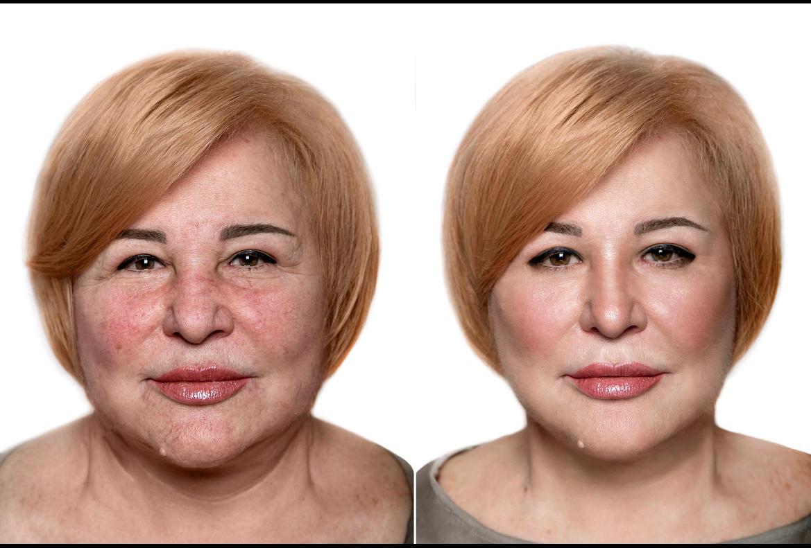 RF Microneedling & Skin Renewal