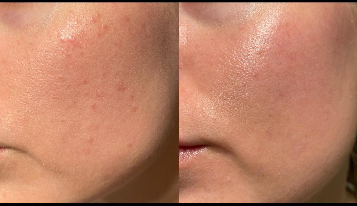 Acne Treatments 2