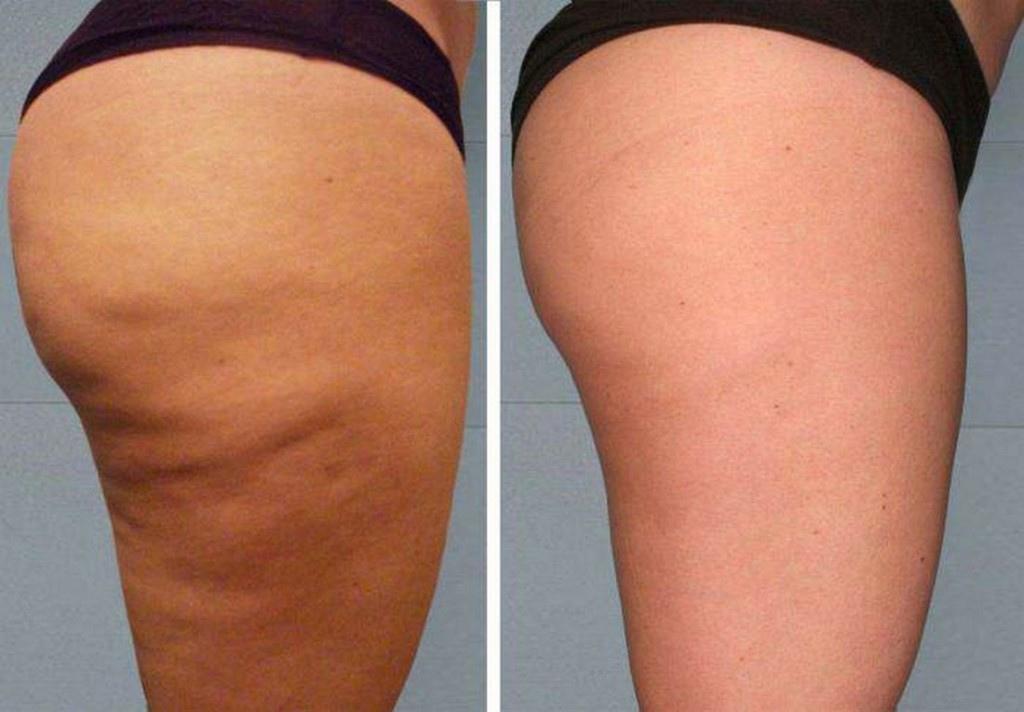 Cellulite Treatments