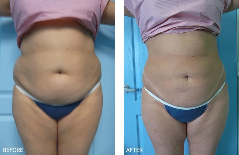 Cryo Fat Reduction
