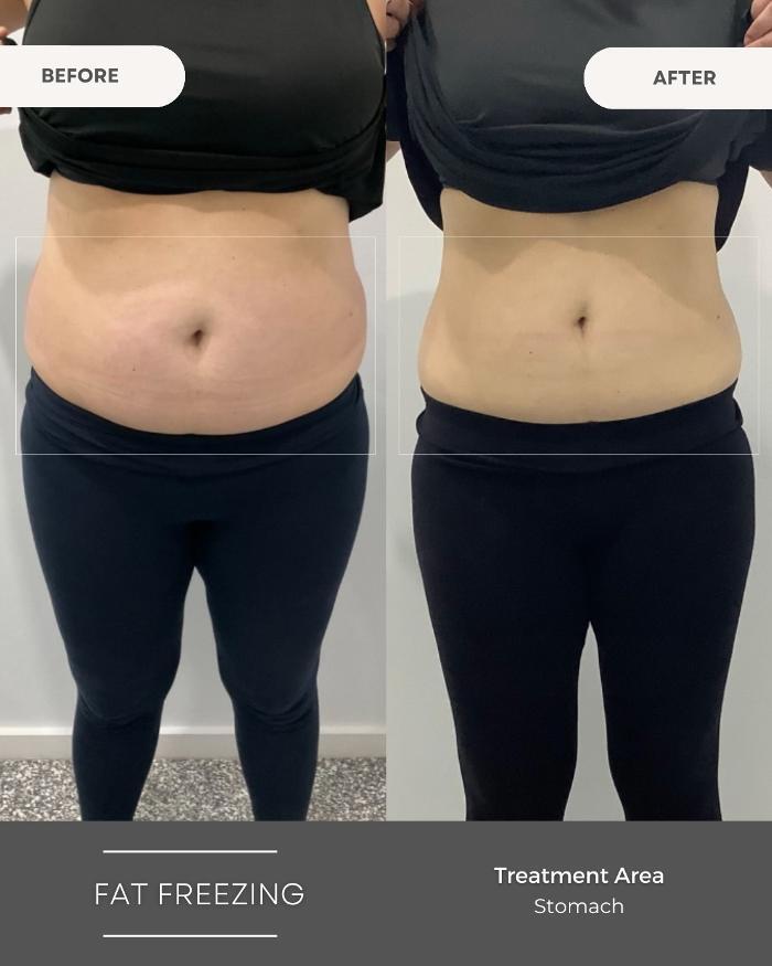 Waist Contouring
